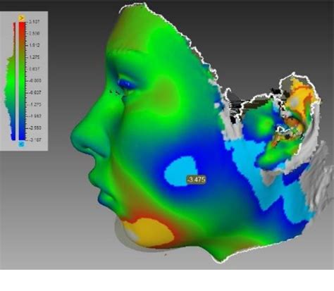 CT ANATOMY OF BUCCAL FAT PAD AND ITS ROLE IN VOLUMETRIC .
